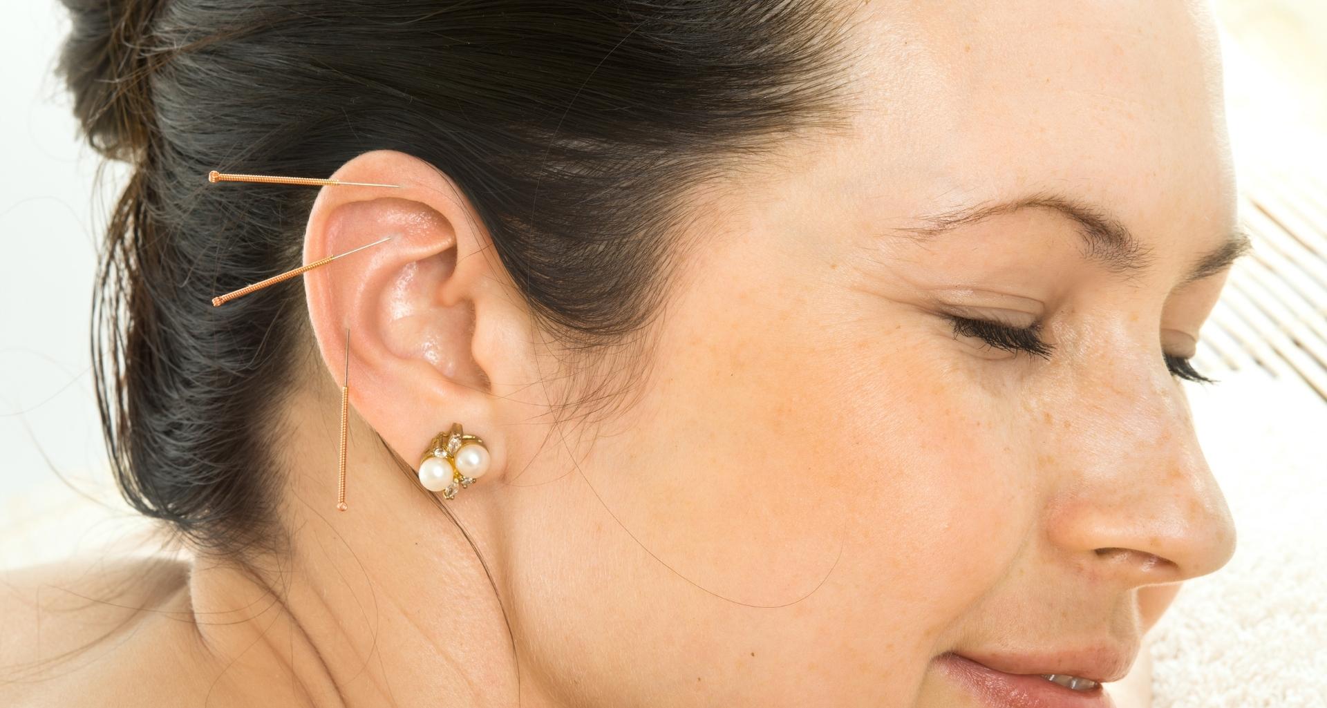 acupuncture suggestion points