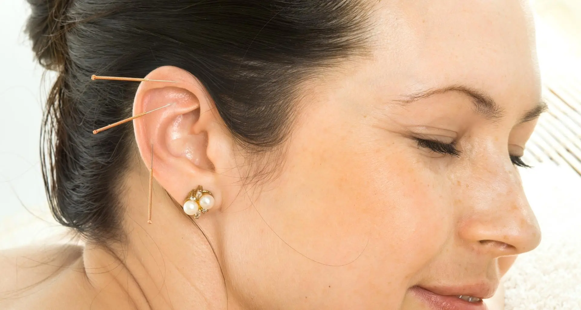 acupuncture suggestion points